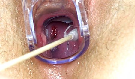 Гинеколог берет мазок